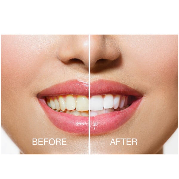 Rio Rio Smile White Advanced Teeth Whitening Kit 50% di sconto per tempo limitato